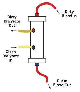 dialyzer hollow fiber hemodialysis dialysis diagram kidney does
