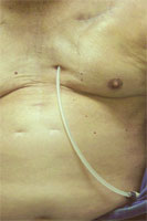 Chest catheter