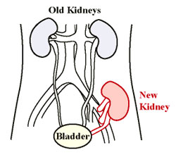 Diagram of kidney transplantation