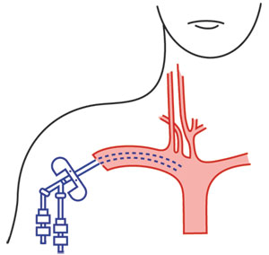 Central venous catheter