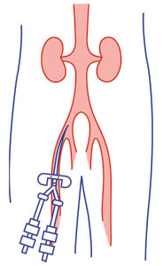 Femoral catheter