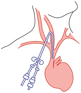 Internal jugular catheter